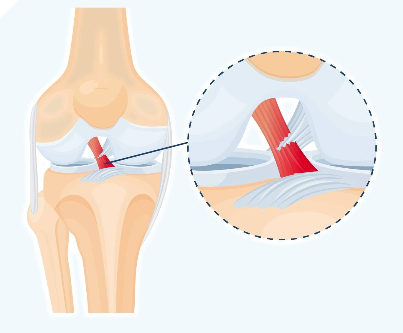 Knee Ligament and Meniscus Care