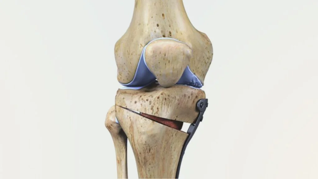 Joint Preservation Surgery