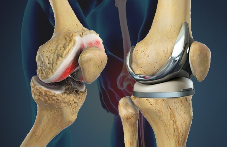 Joint Replacement Arthroplasty